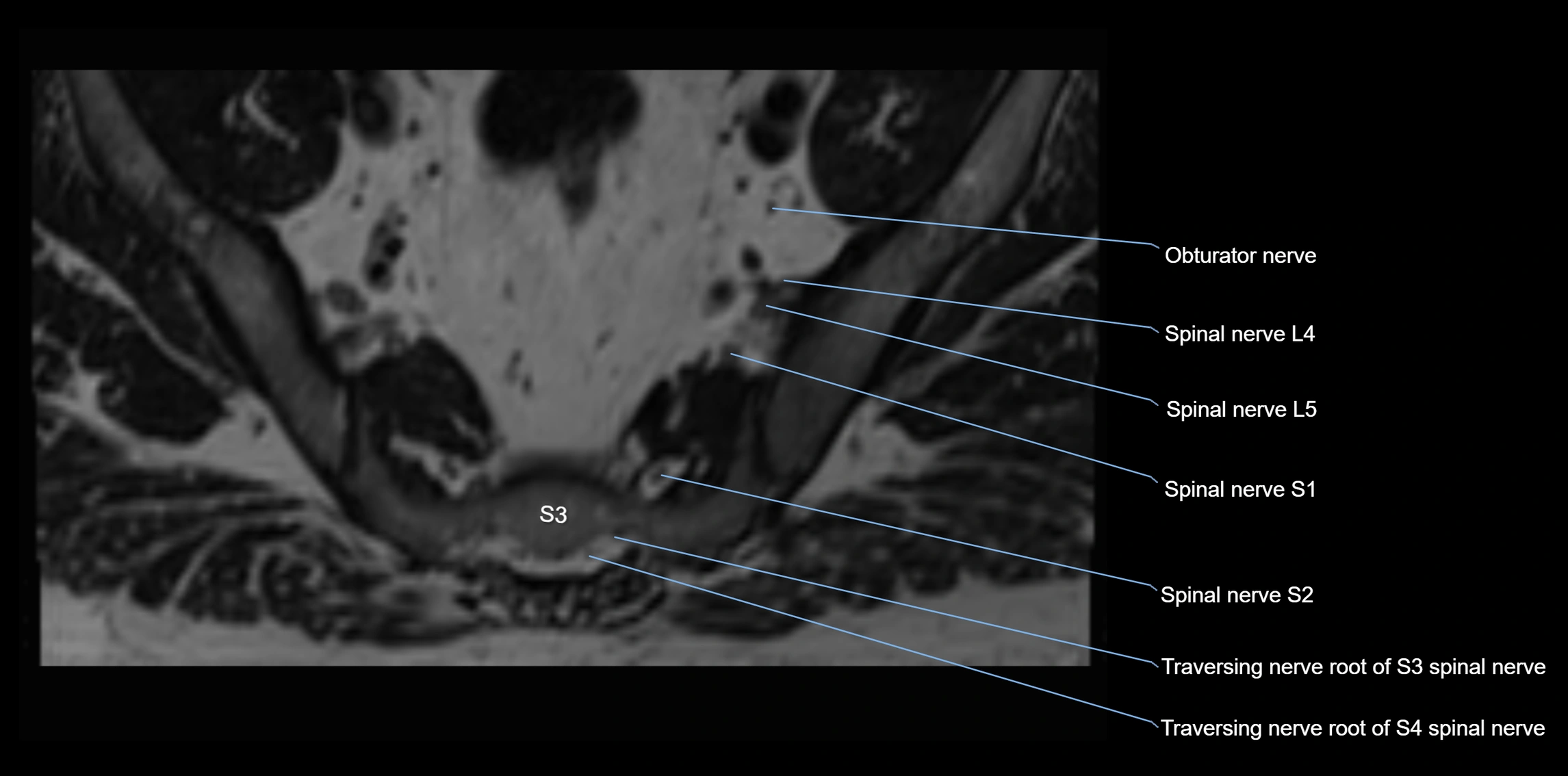 MR lumbosacral plexus axial cross sectional anatomy 3T  radiology  image-img-1008001-00091.webp